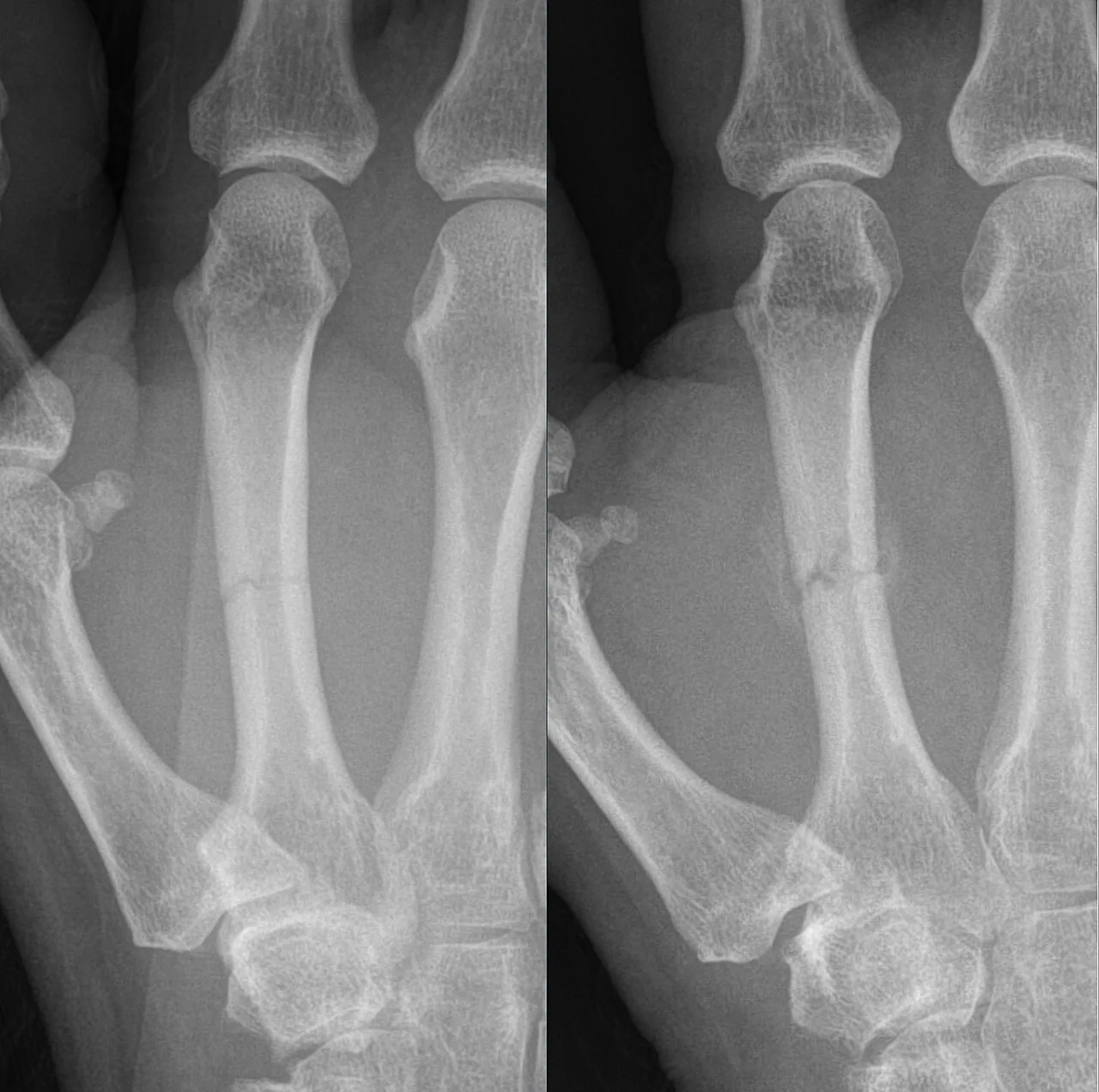 Upper limb radiograph for self-assessment