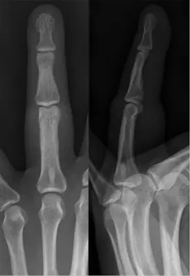 Radiograph from the case bank: Osteoma